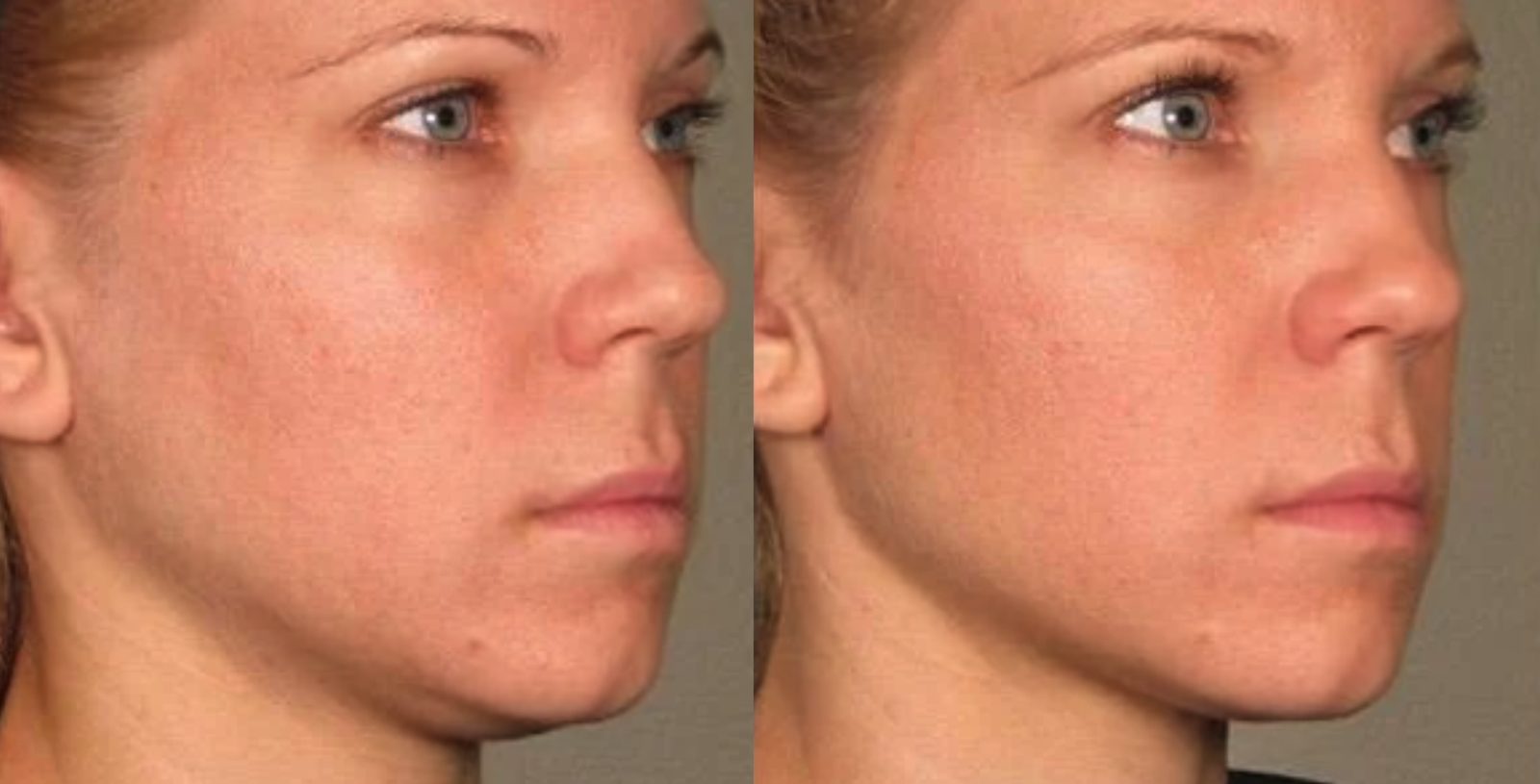 Overall skin tone and clarity, before and after at Skin&Co Mississauga