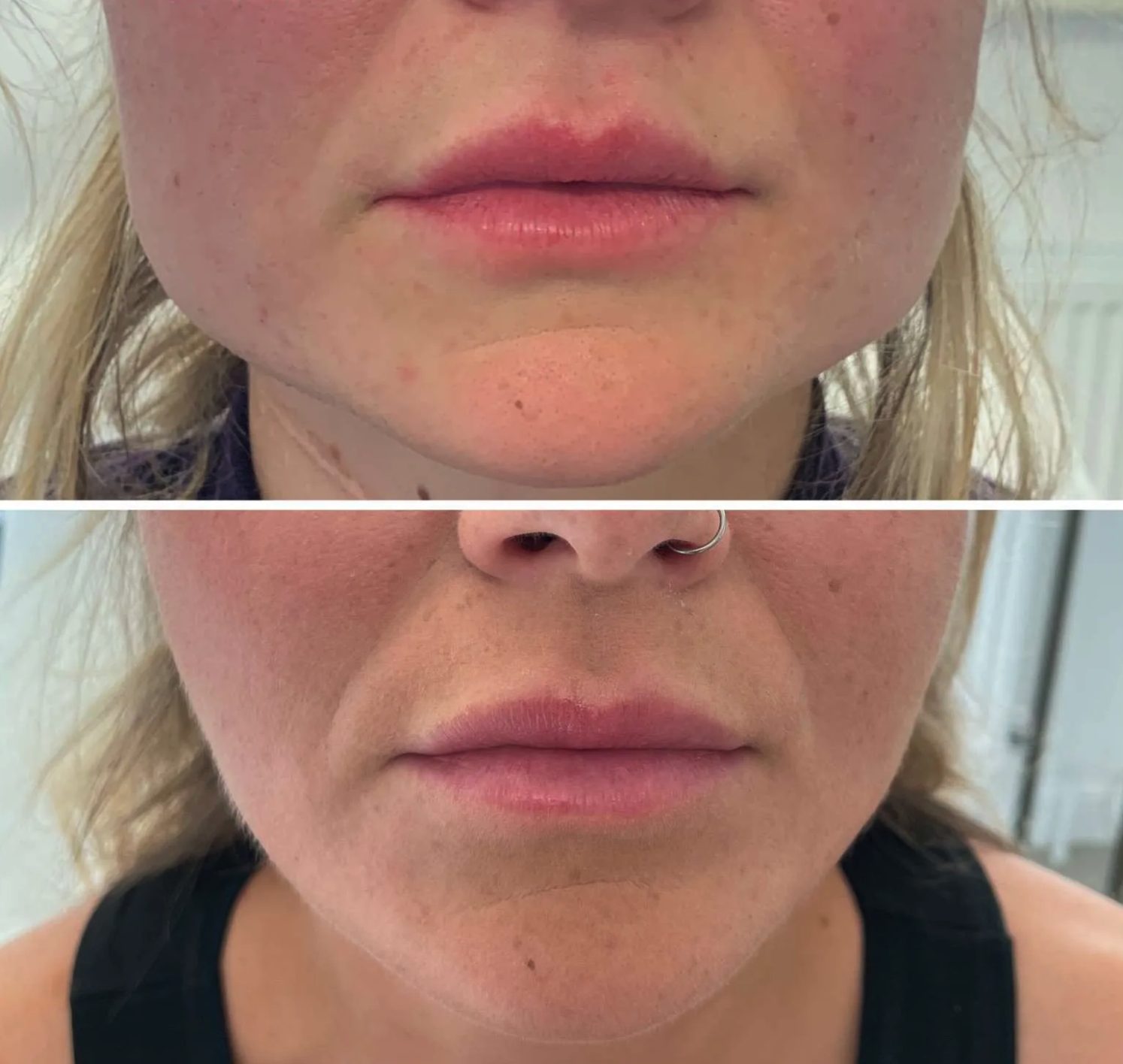 Lip volume and border definition, before and after at Skin&Co Mississauga