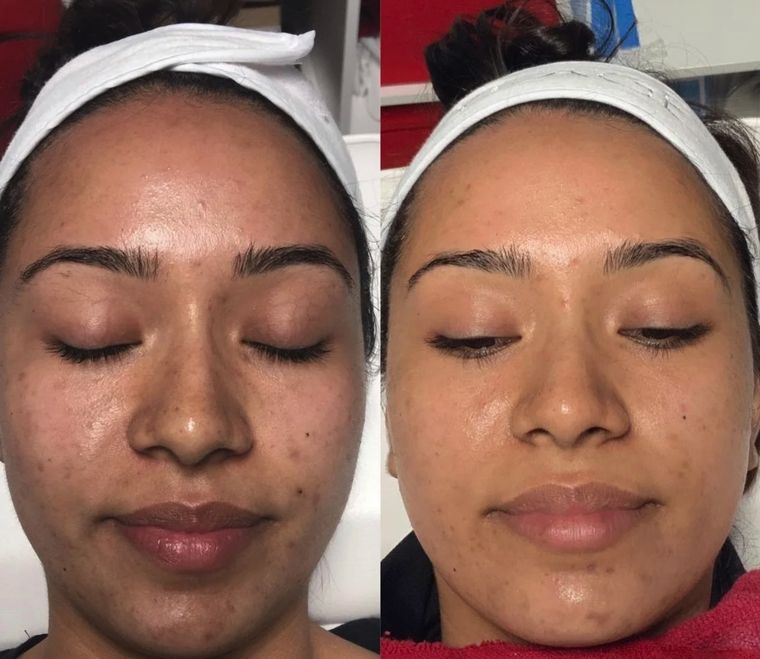 Pigmentation and overall tone, before and after at Skin&Co Mississauga