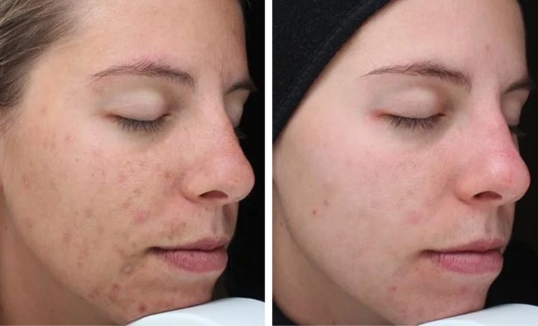Melasma across the cheek, before and after at Skin&Co Mississauga