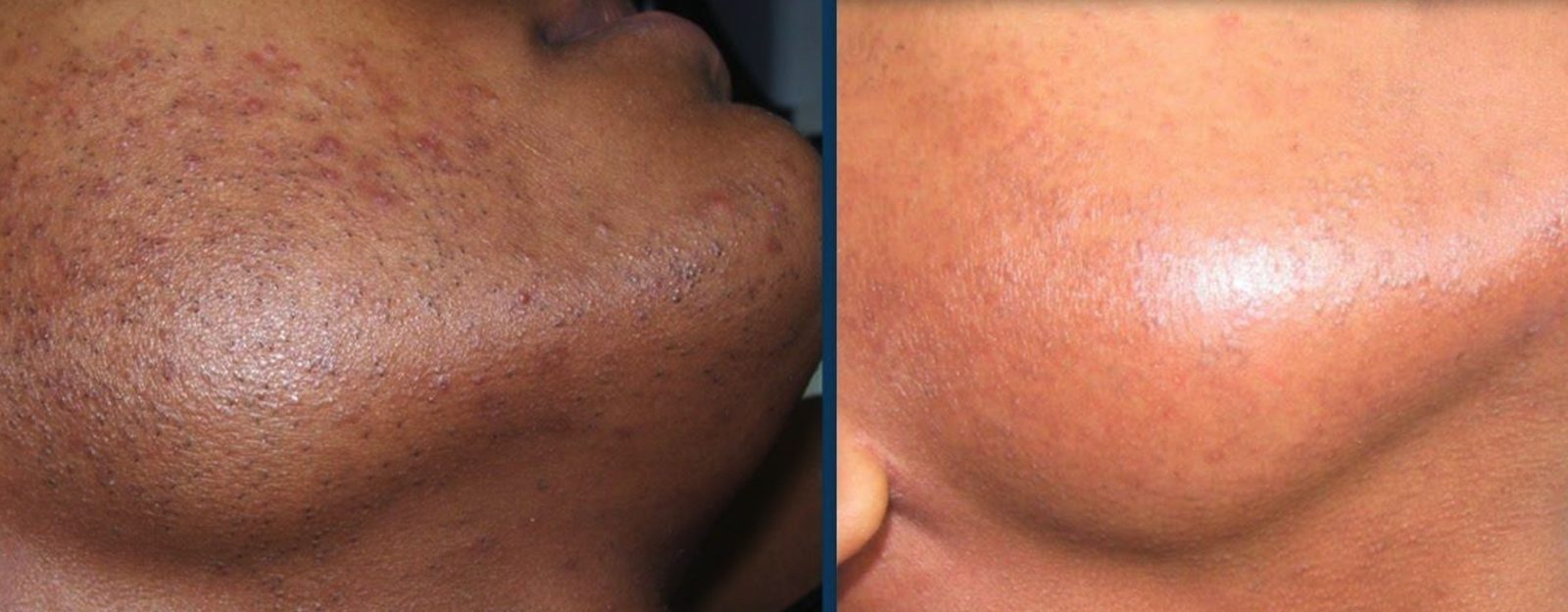 Pigmentation, jaw and neck, before and after at Skin&Co Mississauga