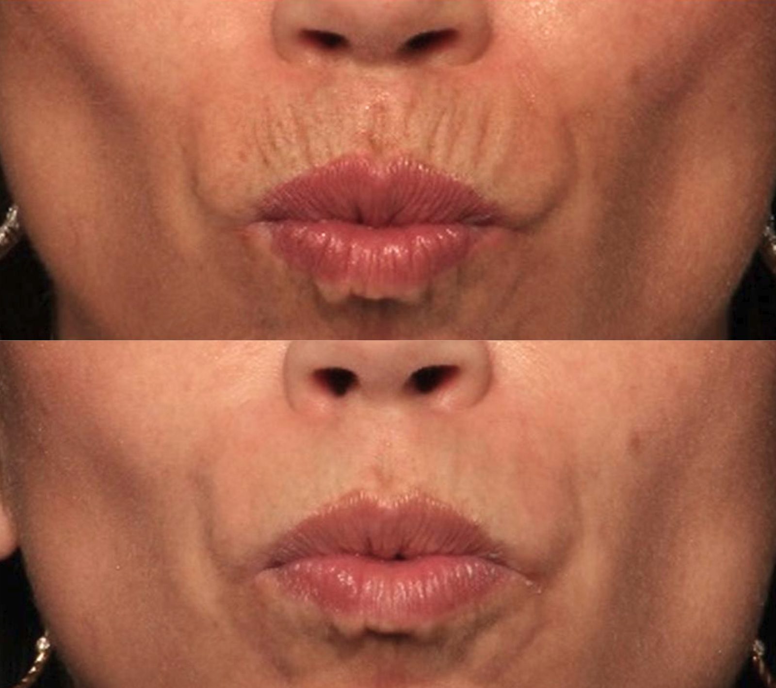 Perioral lines and lip support, before and after at Skin&Co Mississauga