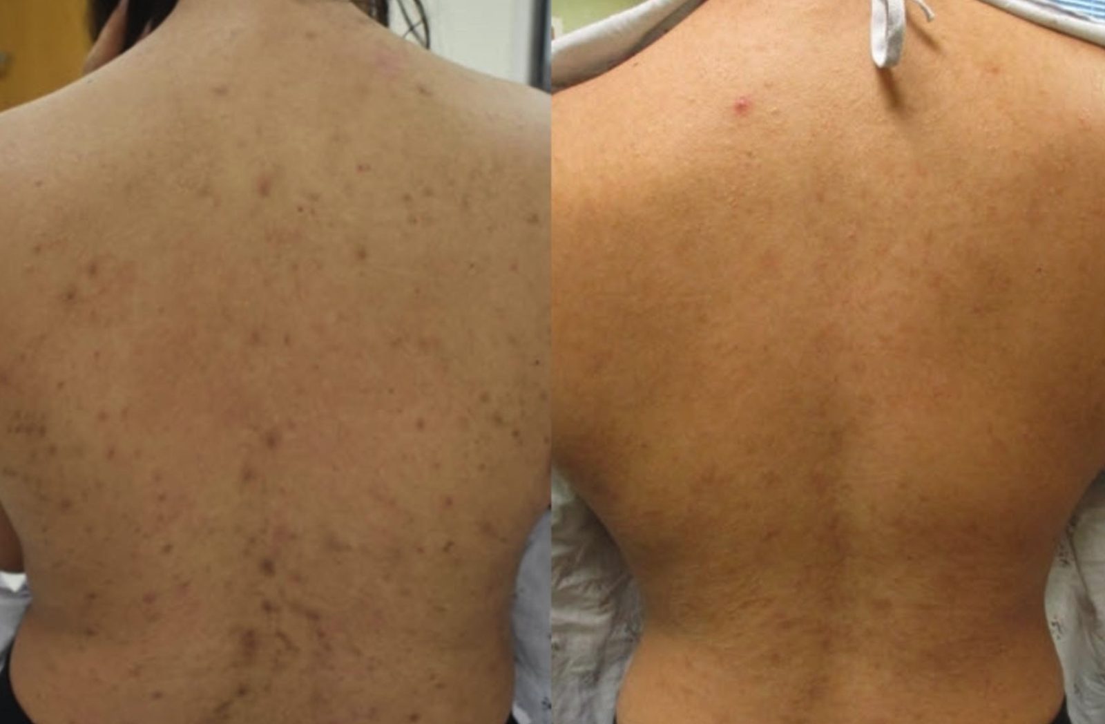 Pigmentation and marks across the back, before and after at Skin&Co Mississauga