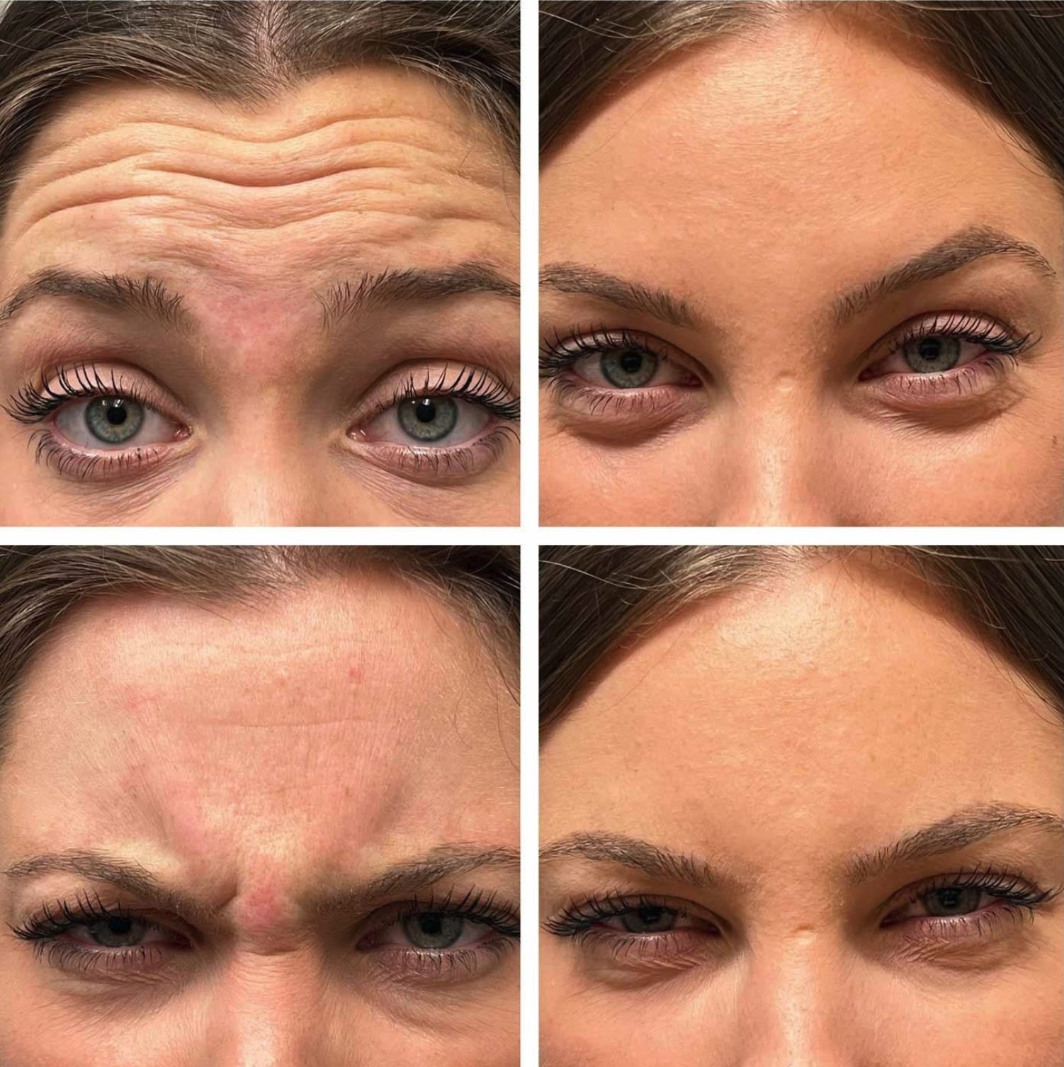Forehead and frown lines, at rest and in movement, before and after at Skin&Co Mississauga
