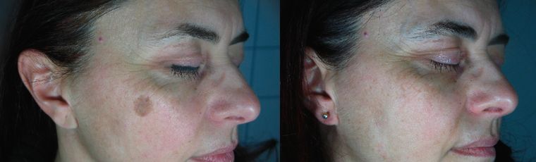 Sun damage and pigmented spots, before and after at Skin&Co Mississauga
