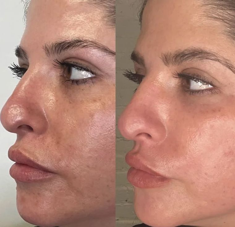 Redness across the nose and cheeks, before and after at Skin&Co Mississauga
