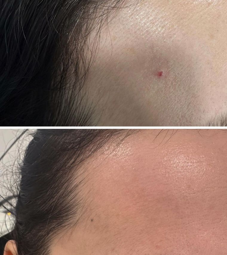 Raised lesion on the forehead, before and after at Skin&Co Mississauga