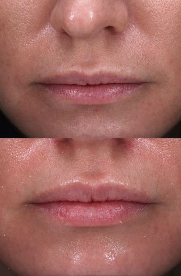 Lip shape and proportion, before and after at Skin&Co Mississauga
