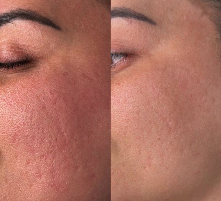 Diffuse redness across the cheek, before and after at Skin&Co Mississauga