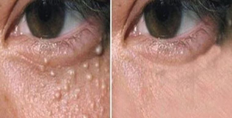 Small raised lesions under the eye, before and after at Skin&Co Mississauga