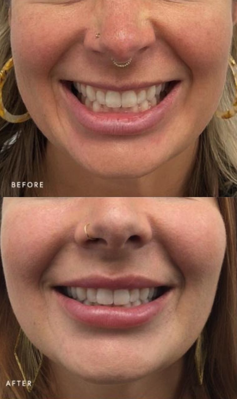 Jawline and under chin profile, before and after at Skin&Co Mississauga