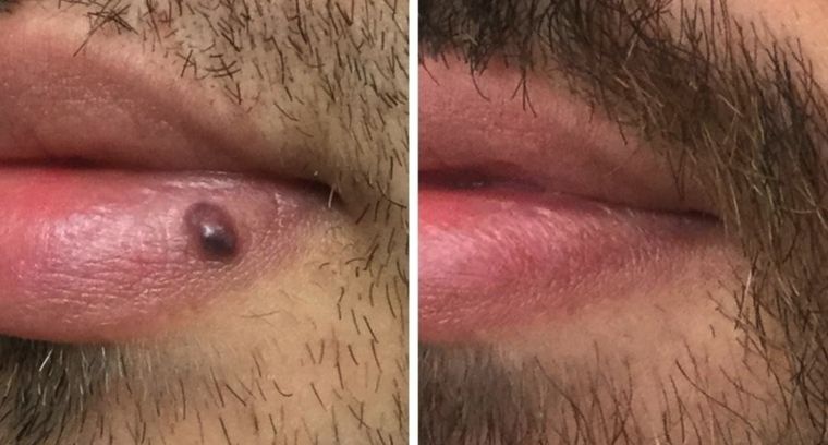 Vascular lesion at the lip border, before and after at Skin&Co Mississauga