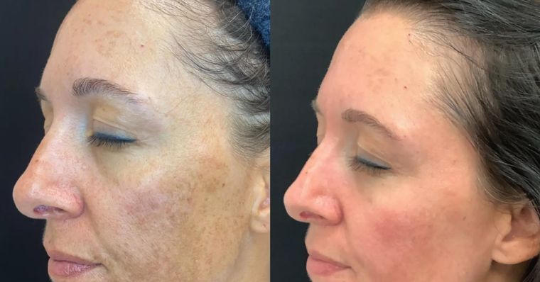 Mid face lift and pigmentation, before and after at Skin&Co Mississauga