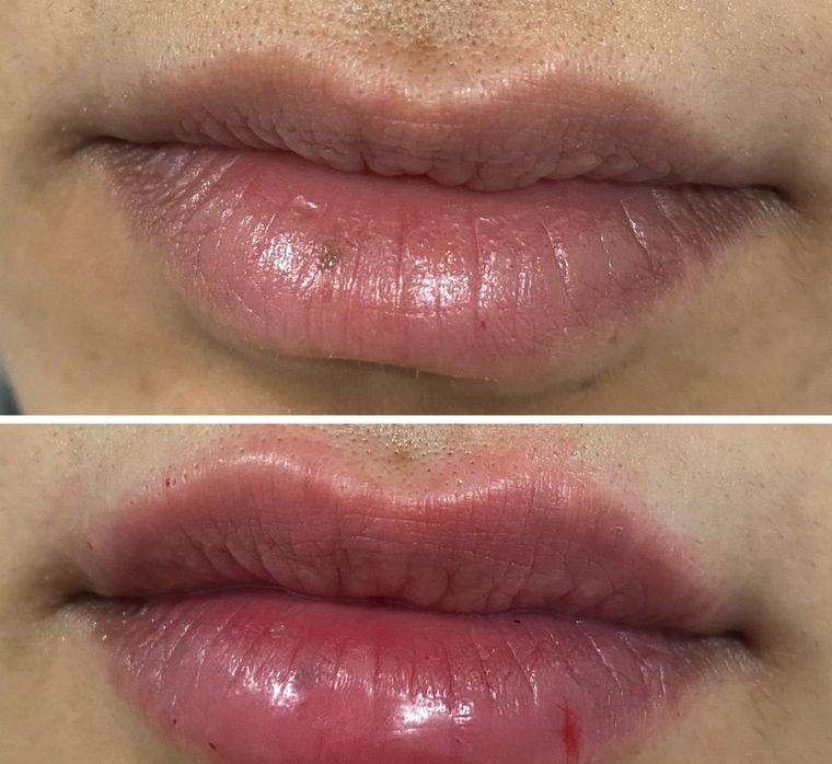 Lip hydration and shape, before and after at Skin&Co Mississauga