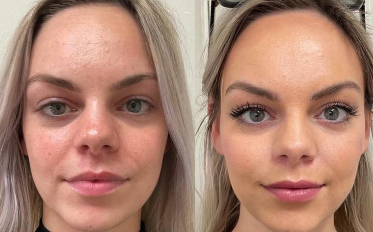 Overall clarity and even tone, before and after at Skin&Co Mississauga